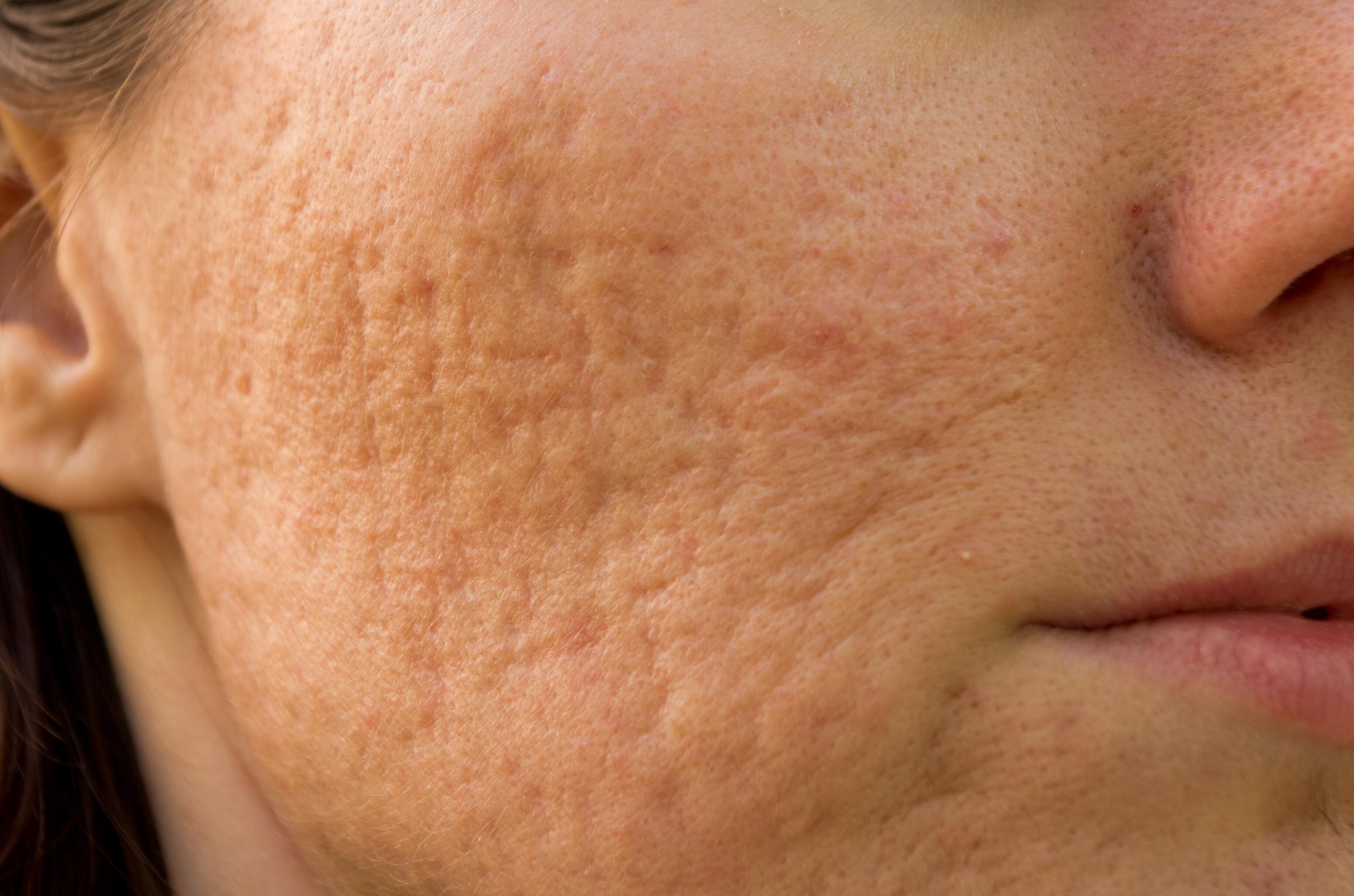 Cicatrici dell’acne ondulate